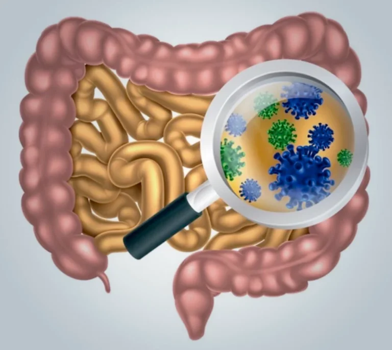 A síndrome do supercrescimento bacteriano no intestino delgado, também conhecida pela sigla SCBID